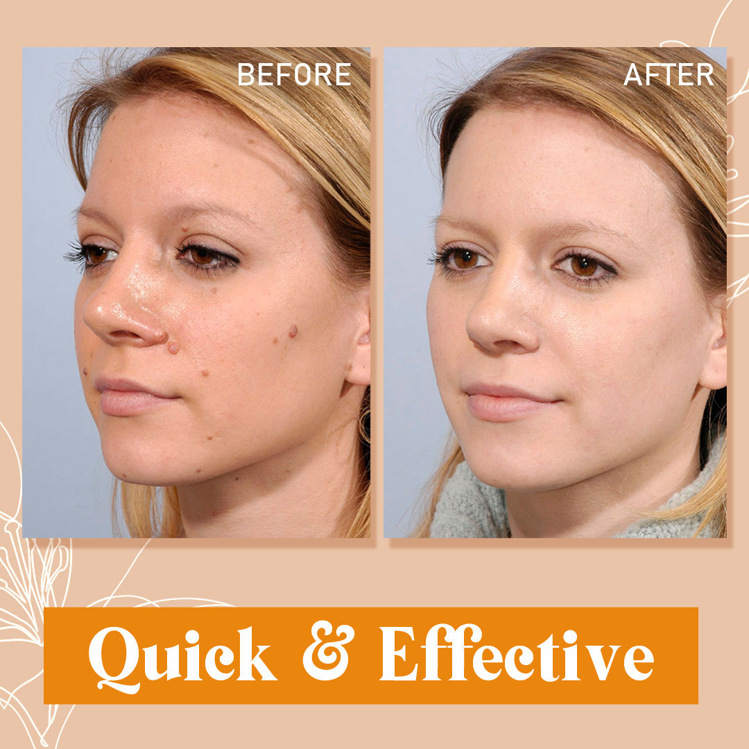 Skin Tag Remover
