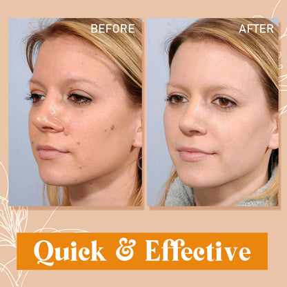 Skin Tag Remover